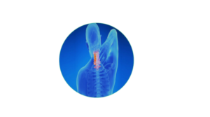Cervical Spondylitis