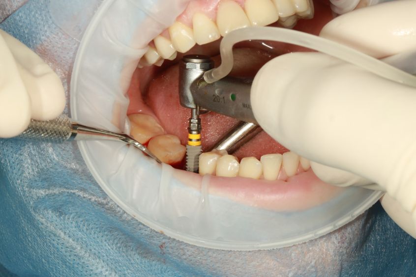 Dental Implants in Dubai, Implantologist in Dubai